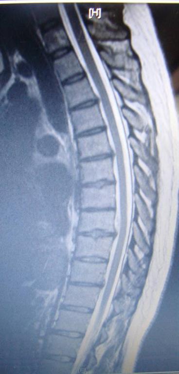 thoracic disc herniation treated by Oxford chiropractor
